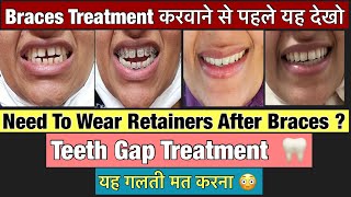 The secret 🤫 Truth About My Braces Journey Braces Off  Retainers ब्रेसेस करवाने से पहले यह देखो [upl. by Bum296]