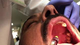 Palatal Anesthetic Infiltration Technique [upl. by Angid]