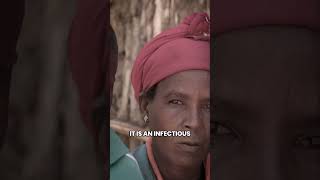 There should be no place for trachoma in todays world [upl. by April]