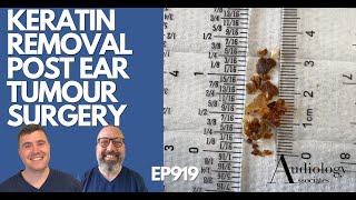 KERATIN REMOVAL POST EAR TUMOUR SURGERY  EP919 [upl. by Fabe]