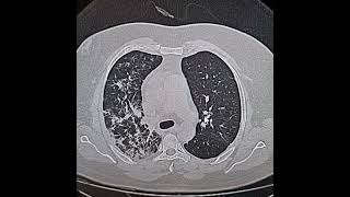 Interstitial pattern 18 of Pneumocystis Jirovici pneumonia and its response to CoTrimoxazole [upl. by Haletta]