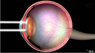 How Macular Degeneration Affects Your Vision  3D animation [upl. by Maltz]