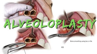 Alveoloplasty [upl. by Kirit683]