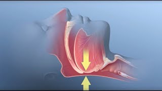 Obstructive Sleep Apnea  Mayo Clinic [upl. by Ettelorahc448]