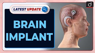 Brain Implant  Epilepsy  Latest Update  Drishti IAS English [upl. by Negroj]