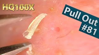 81 Pull Out Blackheads Close up 100X  Blackheads Removal  ピンセットで角栓を抜く [upl. by Evelinn725]