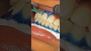 Get pinkish White Teeth At Home shorts ytshorts shortviral [upl. by Batish383]