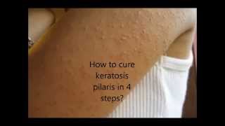 How to cure keratosis pilaris in 4 easy steps [upl. by Murdock78]