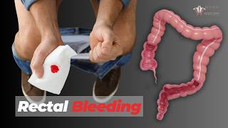 When to Be Worried About Rectal Bleeding [upl. by Idolla631]