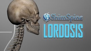 Lordosis [upl. by Loralyn]