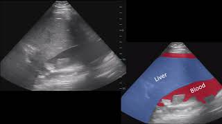 Splenic Rupture FAST Ultrasound 52020 [upl. by Stig]