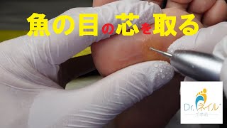 「魚の目」の芯の取り方（胼胝・callus・脚茧）（うおのめ・ウオノメ・魚の目・鶏眼・Corn・티눈・鸡眼）014 [upl. by Ainaled]