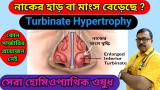 নাকের হাড় বা মাংস বেড়েছে   Nasal Turbinate Hypertrophy  Homeopathic Medicine [upl. by Sirmons61]