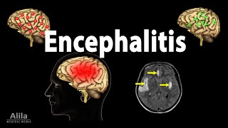 Encephalitis Animation [upl. by Ashil378]