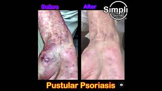 Pustular Psoriasis [upl. by Corel214]