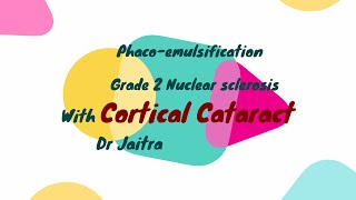 NUCLEAR SCLEROSIS GEADE 2 WITH CORTICAL CATARACT by Dr Jaitra CC2 [upl. by Einnaej]