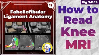 Fig 3B19 Fabellofibular Ligament Anatomy [upl. by Rhetta]