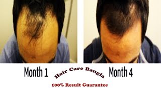 Homeopathic Medicine For Alopecia and Baldness  Hair Care Bangla [upl. by Waynant]