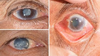 How to Cure Glaucoma Eye Disease  6 Home Remedies for Glaucoma at Home [upl. by Yelwah]