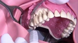 Periodontal surgery Modified Widmann flap [upl. by Clover540]