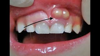 Incision and Drainage  and Penrose Drain Placement [upl. by Retsev193]