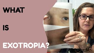 What Is Exotropia And How Do We Treat It [upl. by Meeks]