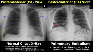 Chest XRay Lung Normal Vs Abnormal Image Appearances Part 2  Pleural EffusionPneumothorax PA CXR [upl. by Petrie]