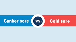 Cold Sores vs Canker Sores — Which Is It [upl. by Akenehs]