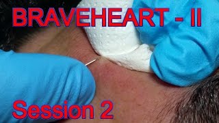 Extraction for Teenage Acne  Session II  Part 2 of 2 [upl. by Conchita410]