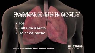 Síntomas del cáncer de pulmón [upl. by Kenwee]