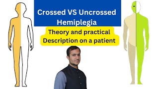 Crossed vs uncrossed hemiplegia pediatrics neurology [upl. by Llerrehs]