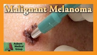 Malignant Melanoma Punch Biopsy  Auburn Medical Group [upl. by Zigmund]