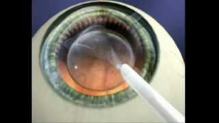 Explication Chirurgie refractive ICL Implant intraoculaire [upl. by Korten]