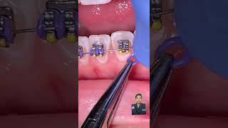 Orthodontist treatment procedure step by step viral video Target 1milne like [upl. by Eixam]