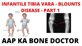 INFANTILE TIBIA VARA OR BLOUNTS DISEASE  PART 1  EPISODE 32 [upl. by Ecirtam]