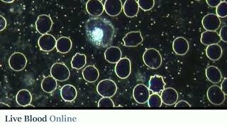 Acanthocytes  Live Blood Analysis Training Course [upl. by Ynohtnad285]