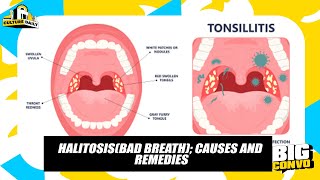 Halitosis Causes Effects And It’s Treatment [upl. by Maiga]