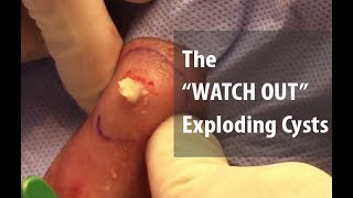 The WATCH OUT Exploding Cysts  Dr Derm [upl. by Morganica]