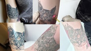 Laser Tattoo Removal Journey  BEFORE amp AFTERS [upl. by Kancler]