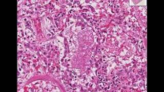 Histopathology LungPneumocystis pneumonia [upl. by Ennovyhs]