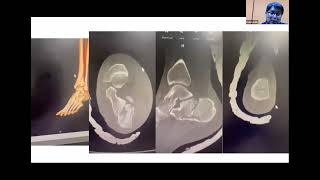 WEBINAR Abordajes en fracturas del calcáneo cual elegir [upl. by Phaedra664]