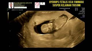 Hydrops Fetalis 11 weeks [upl. by Reinwald542]