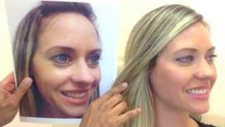 Botox amp Restylane Before amp After [upl. by Waterer747]