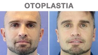 Otoplastia antes y después  Testimonio de David [upl. by Nnaitak220]