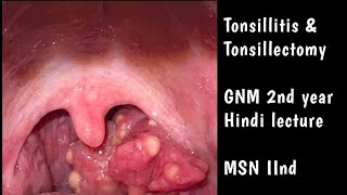 Tonsillitis amp Tonsillectomy  GNM 2nd year  MSN 2nd Hindi Nursing lecture [upl. by Alic366]