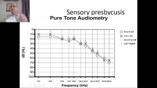 Presbycusis Part 1 [upl. by Assener]