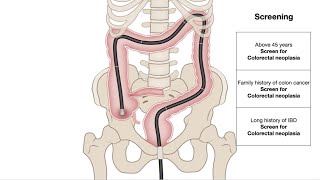 HCC 1475 13 Colonoscopy sigmoidoscopy [upl. by Sheila]