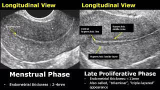 Endometrial Thickness Ultrasound Image Appearances  Endometrium Menstrual Cycle USG Images [upl. by Blancha]