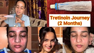 2 Month RetinolTretinoin Journey✨ [upl. by Eenwat]