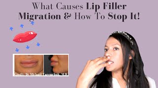 Lip Filler Migration  Causes Prevention amp How To Treat It [upl. by Cralg]